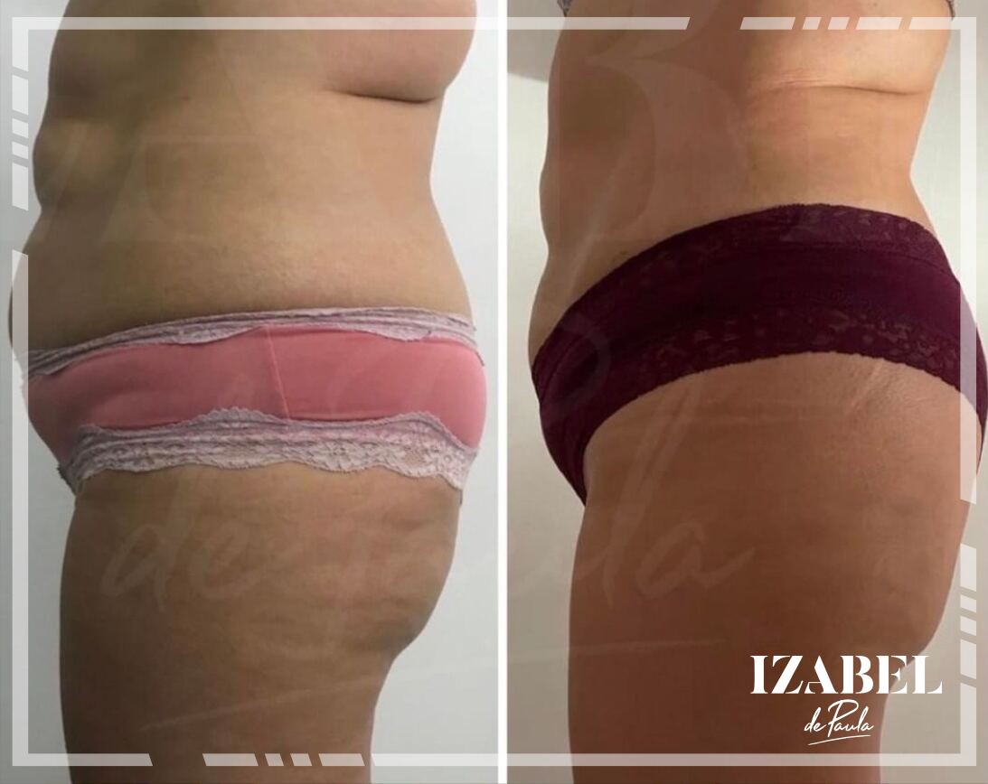 Antes e depois 11
